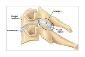 Cervical-Facet-Joint-Syndrome Anatomical diagram of two cervical vertebrae showing the facet joint, facet capsule, cervical disc, and vertebral body
