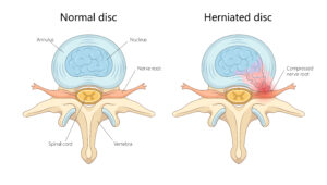 Normal and Herniated Spinal Discs diagram medical Diagram comparing a normal spinal disc with an intact annulus and nucleus to a herniated disc with nucleus material compressing a nerve root