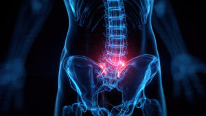 Human anatomy rendering illustrates lower back and sacroiliac joint inflammation against a dark background Digital illustration of the lumbar spine and pelvis highlighting the sacroiliac joint area as a source of lower back pain