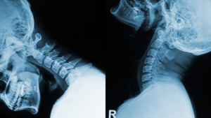 What CRMA Is - xray image.png Flexion and extension cervical spine X-rays used to assess ligament stability and spinal motion
